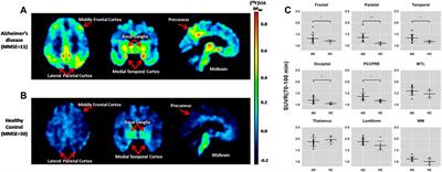 Biodistribution and Dosimetry Evaluation for a Novel Tau Tracer [18F]-S16 in Healthy Volunteers and Its Application in Assessment of Tau Pathology in Alzheimer’s Disease